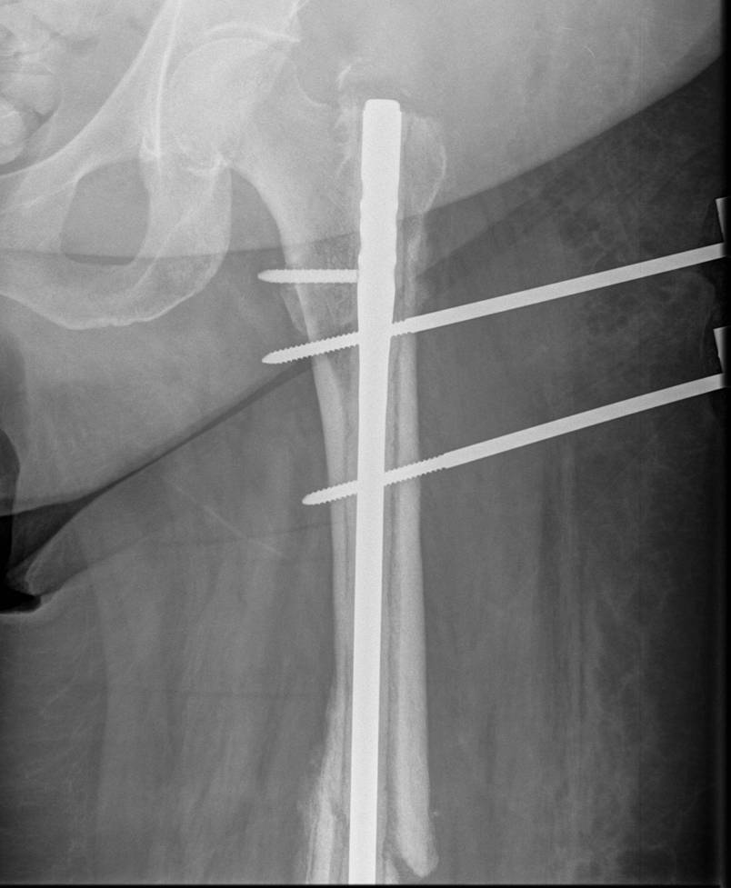 Infected Femoral Nail 1